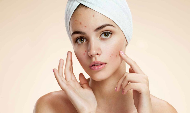 Tisane depurative per acne, 4 ricette fai da te