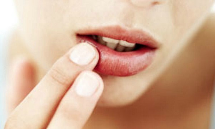 Labbra screpolate e secche, 5 rimedi naturali fai da te